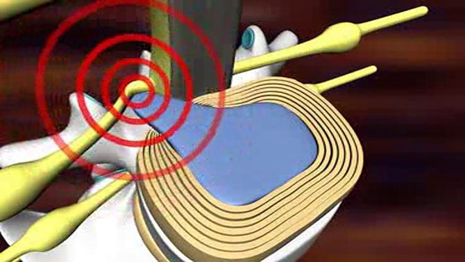 Informationsvideo zum Thema 'Bandscheibenvorfall'